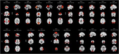 Abnormal static and dynamic functional network connectivity in stable chronic obstructive pulmonary disease